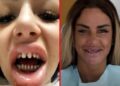 Advertencia sobre la peligrosa tendencia estética de los «dientes turcos»