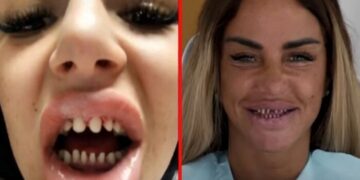 Advertencia sobre la peligrosa tendencia estética de los «dientes turcos»