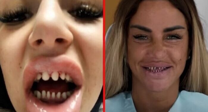 Advertencia sobre la peligrosa tendencia estética de los «dientes turcos»