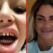 Advertencia sobre la peligrosa tendencia estética de los «dientes turcos»