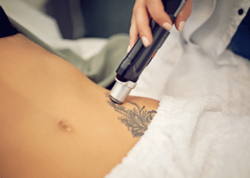 Eliminar tatuajes en Cantabria y las peores aberraciones del «body art»