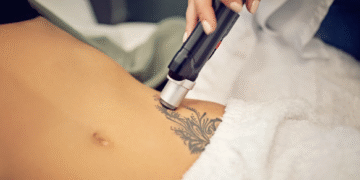 Eliminar tatuajes en Cantabria y las peores aberraciones del «body art»