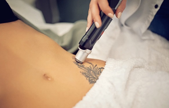 Eliminar tatuajes en Cantabria y las peores aberraciones del «body art»