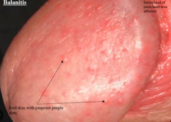 Urólogo en Santander nos cuenta cómo se ve la balanitis en hombres