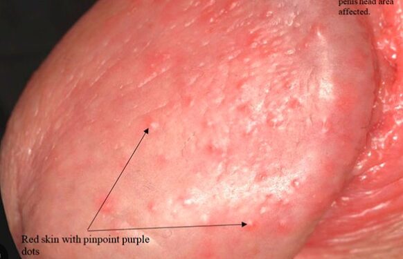 Urólogo en Santander nos cuenta cómo se ve la balanitis en hombres